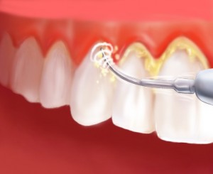 آیا جرم گیری برای دندان مضر است ؟
